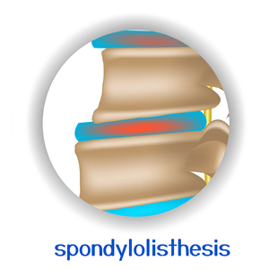 picture of Toronto spondylolisthesis